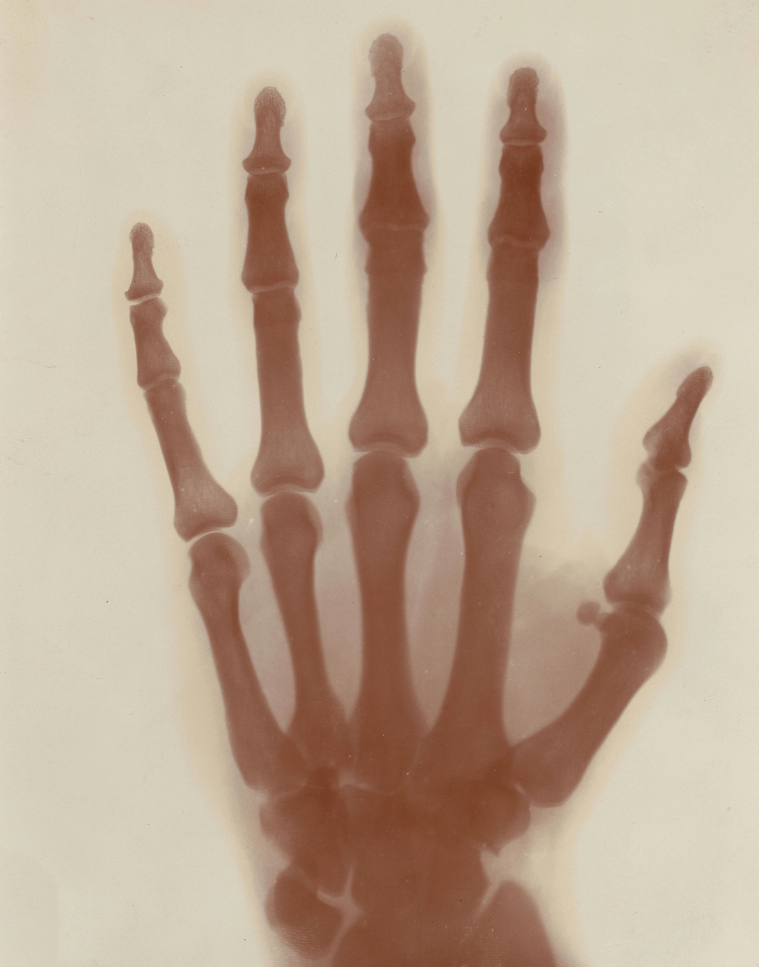 xray tesla hand